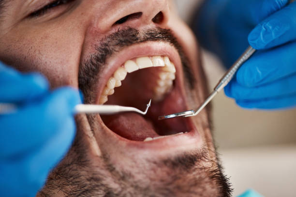Best Emergency Tooth Extraction in Russellville, AL